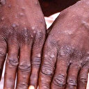 Nijerya'da maymun çiçeği virüsünden ilk ölüm kayıtlara geçti