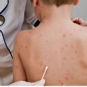 Fransa’da maymun çiçeği alarmı: Vaka sayısı 16 olarak açıklandı