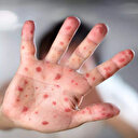 İngiltere'de maymun çiçeği vakalarında büyük artış