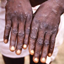 Lübnan'da ilk maymun çiçeği vakası tespit edildi