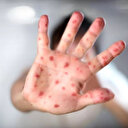 Türkiye'de ilk vaka: Maymun çiçeği hangi ilde görüldü? Nasıl bulaşır?