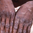 Uzmanından 'maymun çiçeği' açıklaması: Telaşlanacak durum yok