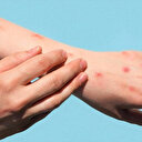 Almanya'da maymun çiçeği virüsü büyüyor: Vaka sayısı 2 bini aştı