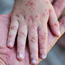 ABD'de ilk kez çocuklarda maymun çiçeği virüsü görüldü