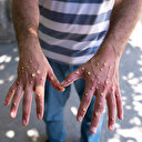 CDC uyardı: AIDS ve maymun çiçeği birlikte ölümcül olabilir