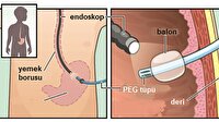 Peg nedir?