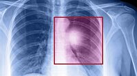 "Akciğer Kanseri Yol Haritası" açıklandı
