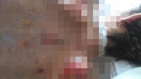Engelli çocuğun sırtını bu hale getirdiler