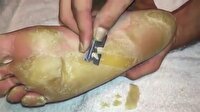 Ayağındaki nasırları jiletle kesen adam