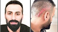 Saç ekimine 'taksirle yaralama' soruşturması