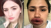 Silikon mağduru Merve hemşirenin son hali