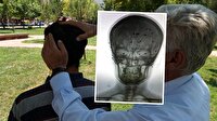 12 yıldır başındaki 80 saçmayla yaşıyor
