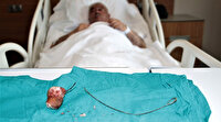Unutulan 28 santimlik stent 7 yıl sonra fark edildi