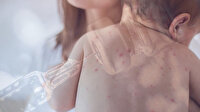 İlk bulgular görülmeye başlandı: Aşı karşıtlarının 10 iddiası ve gerçekler