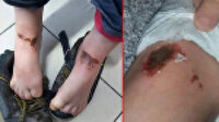 Afyonkarahisar'da karla oynarken yaralanan öğrencilerde yanığa neden olan madde tespit edildi