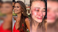 Dünyaca ünlü model tanınmaz halde: Daria Kyryliuk Çeşme'de feci şekilde darp edildi