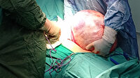 Niğde'de doktorları şaşırtan tümör hastanın karnından çıktı: 40 santimetre çapında 5 buçuk kilo ağırlığında