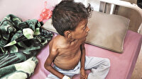 Yemen’de 400 bin çocuk hayatını kaybedebilir