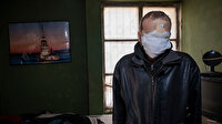15 yıl önce hayatı kabusa dönen cilt kanseri baba: Suratım, burnum, dudaklarım ve damağım yok