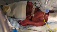 648 gram doğdu 3 ay yoğun bakımda kaldı: Umut bebek hayata tutunmayı başardı