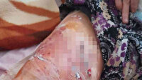 Antalya'da Pitbull'ların saldırdığı kadın yaralandı: Gitti geldi yine ısırdı