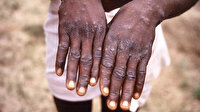 Maymun çiçeği Afrika'da can aldı