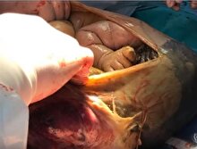 625 milyonda bir görülen doğum "Mucize bebek"