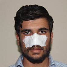 Kavga ettiği kuzeninin burnunu ısıran genç, burnun belli bir kısmını kaçırdı