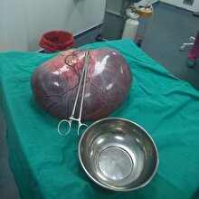 Kilo aldığını sanan kadında 9 kilo kitle çıktı