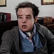 Dünyada bir ilk: Aynı kişiye iki kez yüz nakli yapıldı