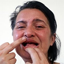 Bembeyaz diş istedi 32 dişini birden kaybetti