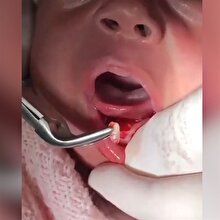 Doğar doğmaz dişi çekilen bebek