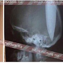 Burun tıkanıklığı yüzünden nefes alamayan adam kafasını deldi