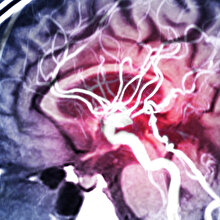 Epilepsi nöbetlerini önceden tahmin eden bir yapay zekâ geliştirildi