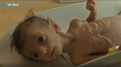 UN says Yemen is a living hell for children