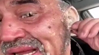 شاهد.. تجمدت أُذن هذا الرجل بسبب الثلوج والبرد القارص