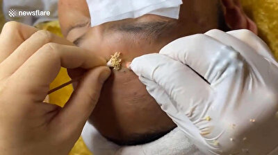 Dermatologist pops stringy greasy pimples on Vietnamese man's forehead