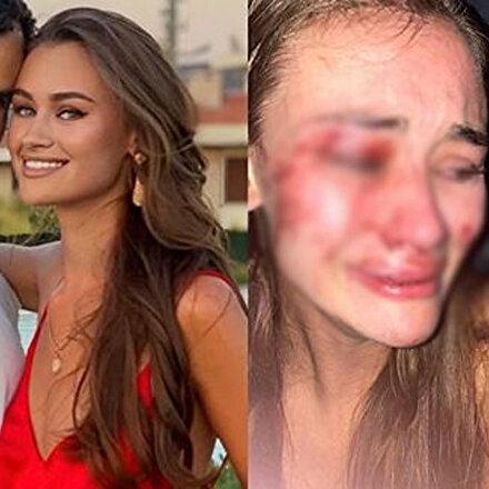 Dünyaca ünlü model tanınmaz halde: Daria Kyryliuk Çeşmede feci şekilde darp edildi