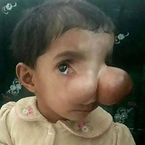 Hastalığı yüzünden ‘lanetli bebek’ diyorlar