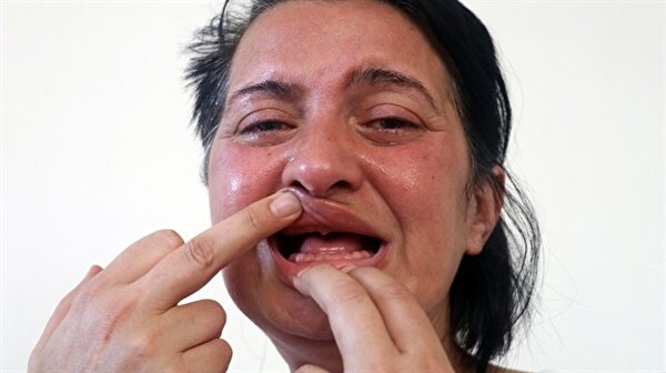 beyaz dis istedi 32 disinden oldu trigmeninal nevralji nedir yeni safak beyaz dis istedi 32 disinden oldu trigmeninal nevralji nedir yeni safak