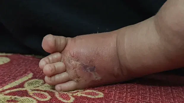 Le pied de Jannah Mutair présente des signes de lésions cutanées alors qu'elle se repose sur un lit au complexe médical Nasser à Khan Yunis, Gaza, le 8 novembre 2025. 