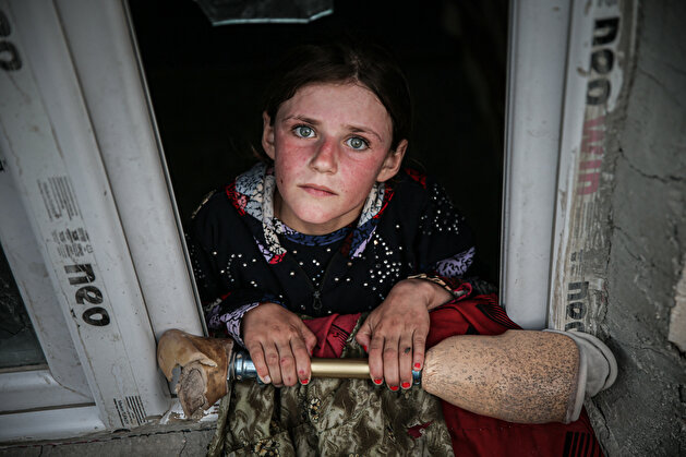 Syrian girl wishes for prosthetic leg to continue school