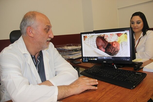 Two-headed Syrian baby born in Turkey’s south