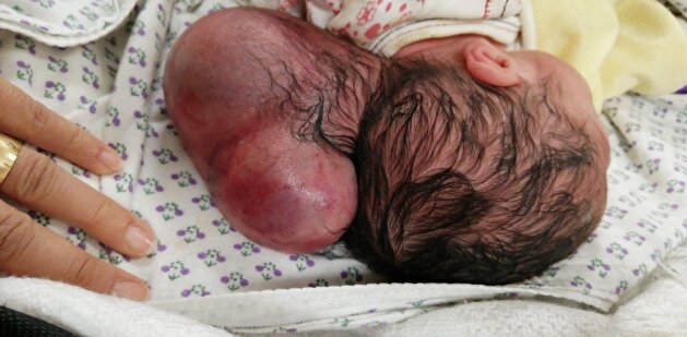 Two-headed Syrian baby born in Turkey’s south
