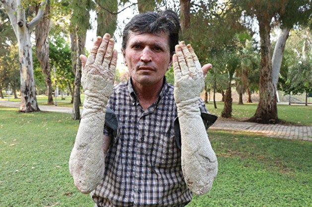 Scaly skinned man calls out for help