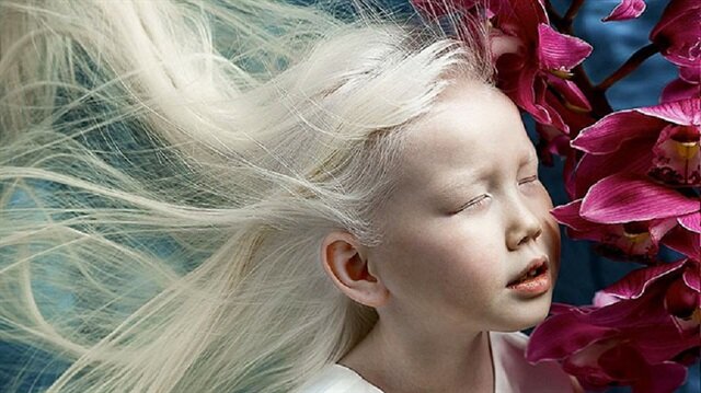 D​ünyanın en güzel ve en popüler albino kızı Nariyana