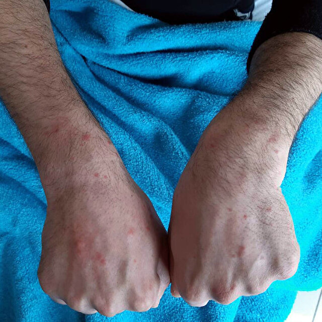 Cerrahpasa Daki 210 Hasta Incelendi Covid 19 Un Deriye Etkisi Nedir