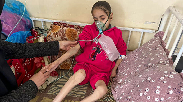 <p>الطفلة نور من غزة تعيش في قبضة الموت بسبب سوء التغذية والجفاف الشديد</p>