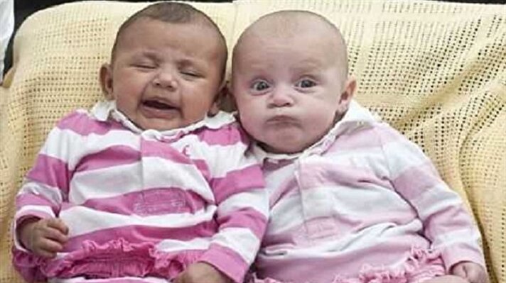 Sheffield Üniversitesi'nden Profesör Allan Pacey, Aynı yumurta ikizleri olan bebeklerin farklı saç veya göz rengine sahip olabilecekleri gibi farklı cilt rengiyle de doğabilirler. Farklı cilt renkleri ebeveynlerin genlerinden kaynaklanmaktadır dedi.