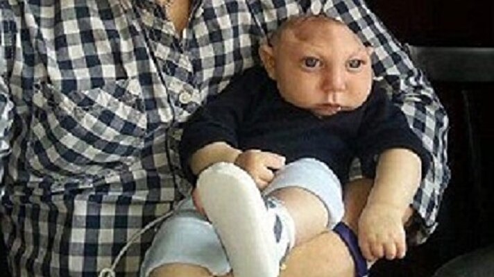 Jaxon Emmett Buell isimli bebek ABD'de yaklaşık 4,859 yenidoğanda 1 görülen "Mikrohidrasefali"" rahatsızlığına sahip.